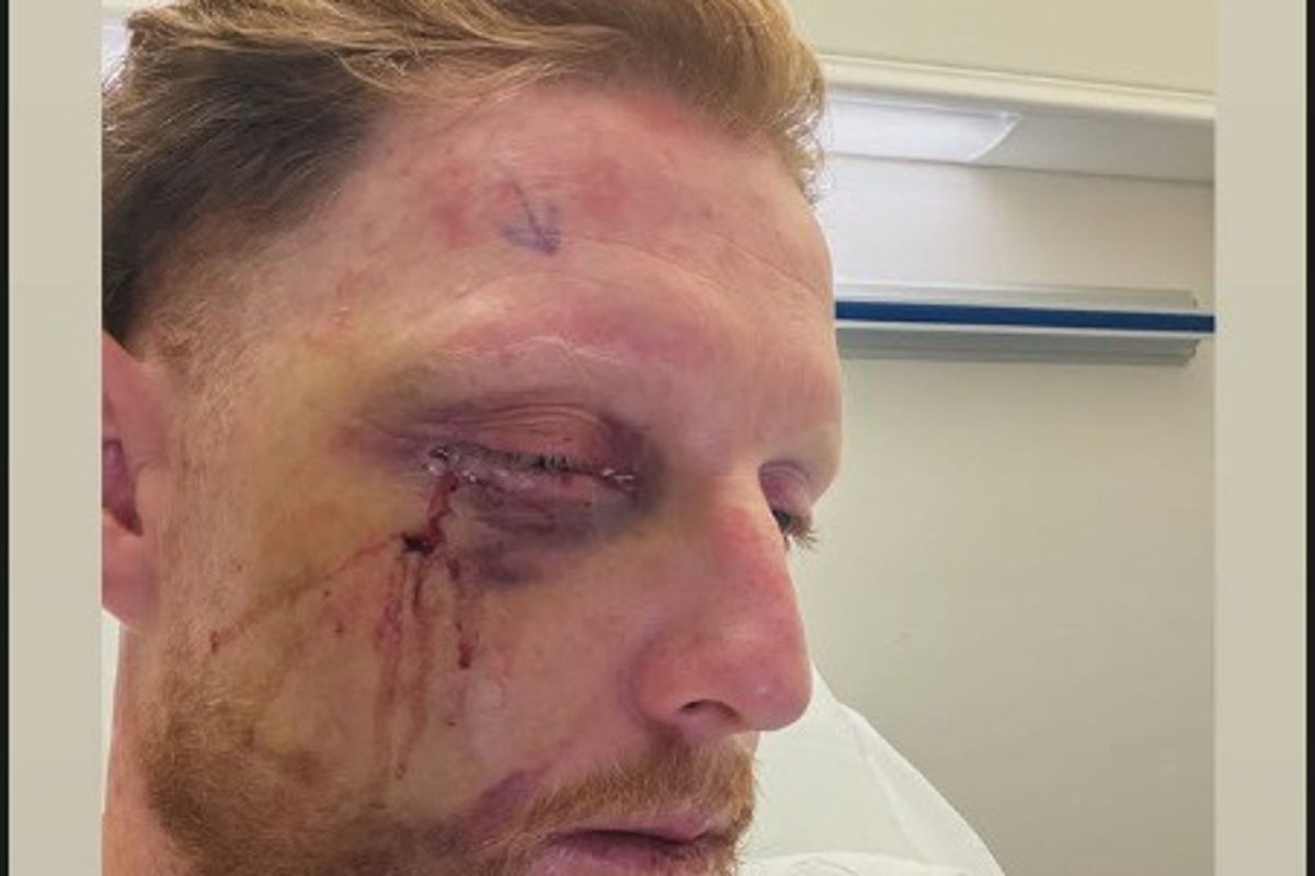 Ben Stokes undergoes surgery after suffering gruesome facial injury